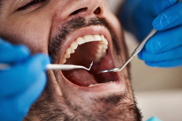 Best Emergency Dental Care for Broken or Chipped Teeth in University Place, WA